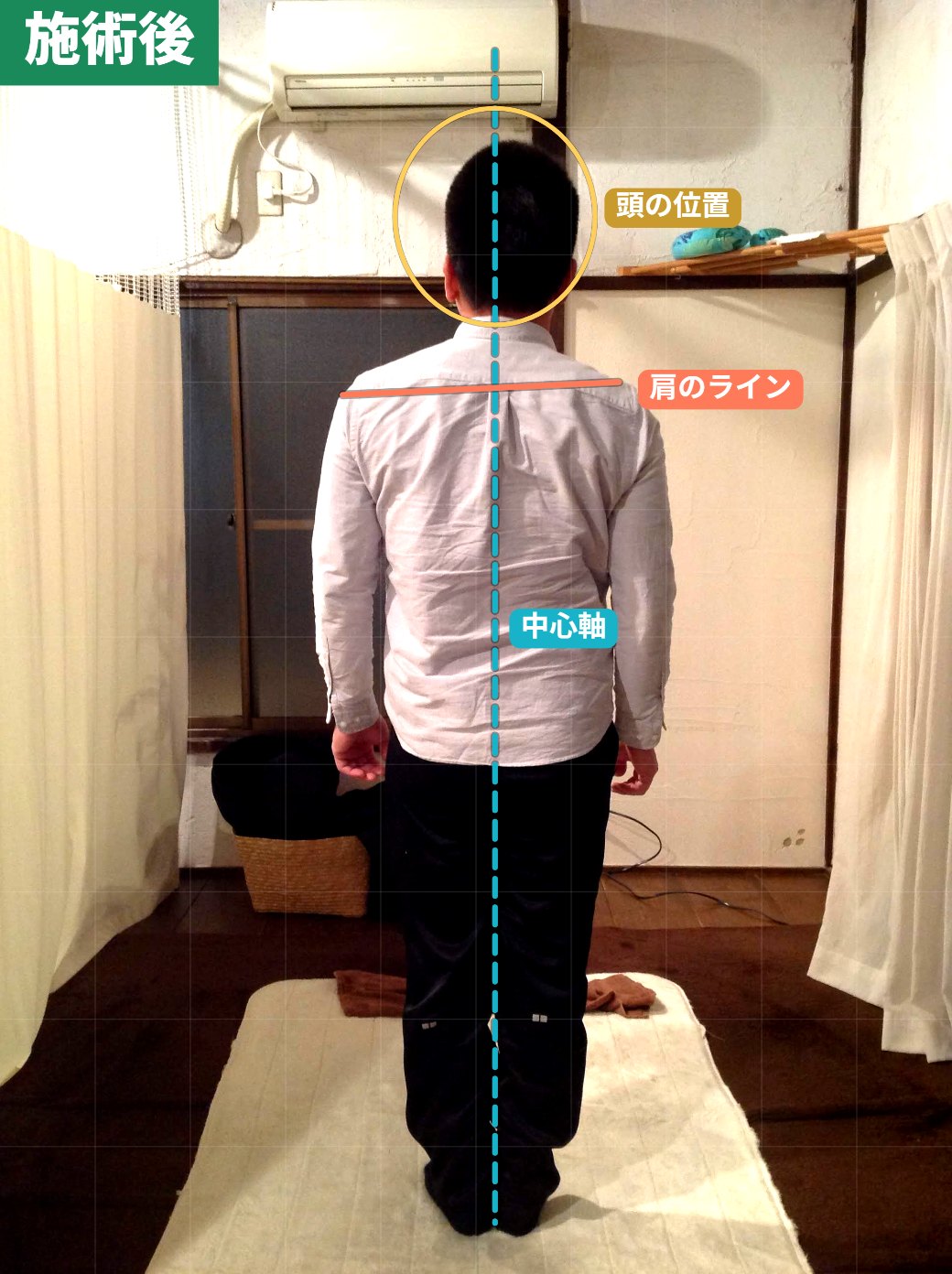 バランス調整術の施術後(背面)。頭の位置が整い、背すじが伸びた状態