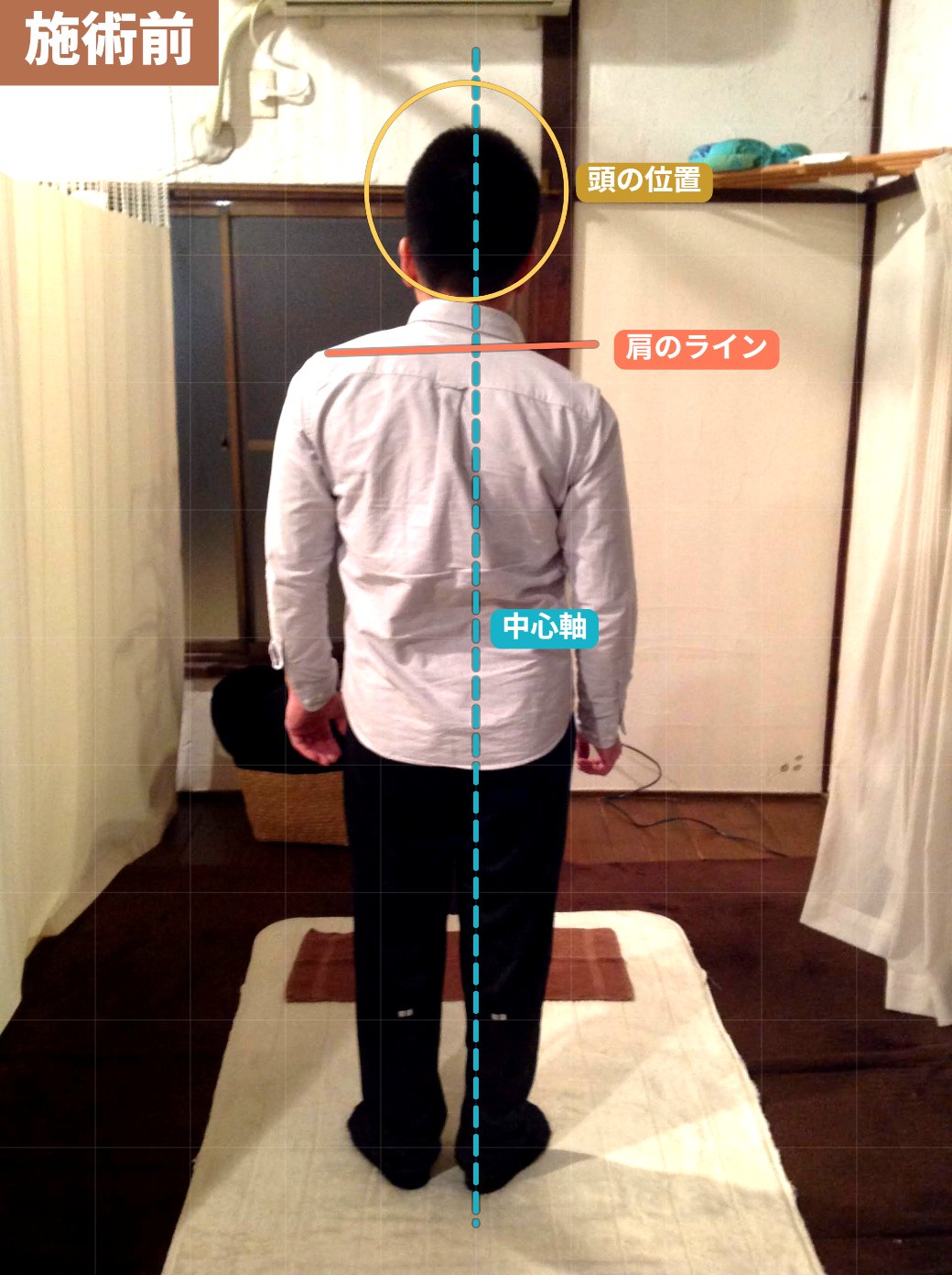バランス調整術の施術前(背面)。頭が前に下がり、背中が丸くなった状態