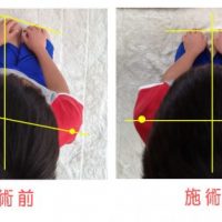 バランス調整術（整体）の比較写真